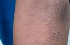 Viêm nang lông vùng kín - nguyên nhân và điều trị