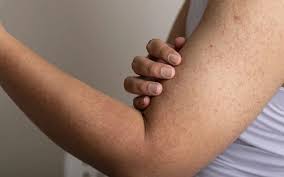 Viêm nang lông ở nách - dấu hiệu và nguyên nhân