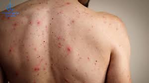 Viêm nang lông ở lưng - hình ảnh lâm sàng