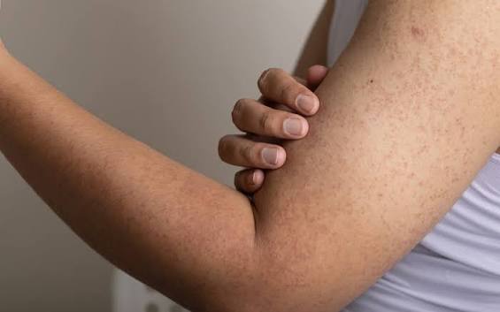 Viêm nang lông da đầu - triệu chứng và điều trị