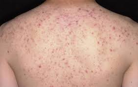 Hình ảnh triệu chứng viêm nang lông