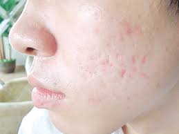 Phân biệt dày sừng nang lông và mụn trứng cá - hình ảnh so sánh