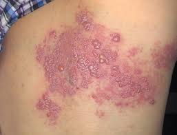 dày sừng nang lông và bệnh vảy nến - Phân biệt vảy nến và dày sừng nang lông - hình ảnh so sánh