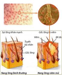Sơ đồ cơ chế viêm nang lông