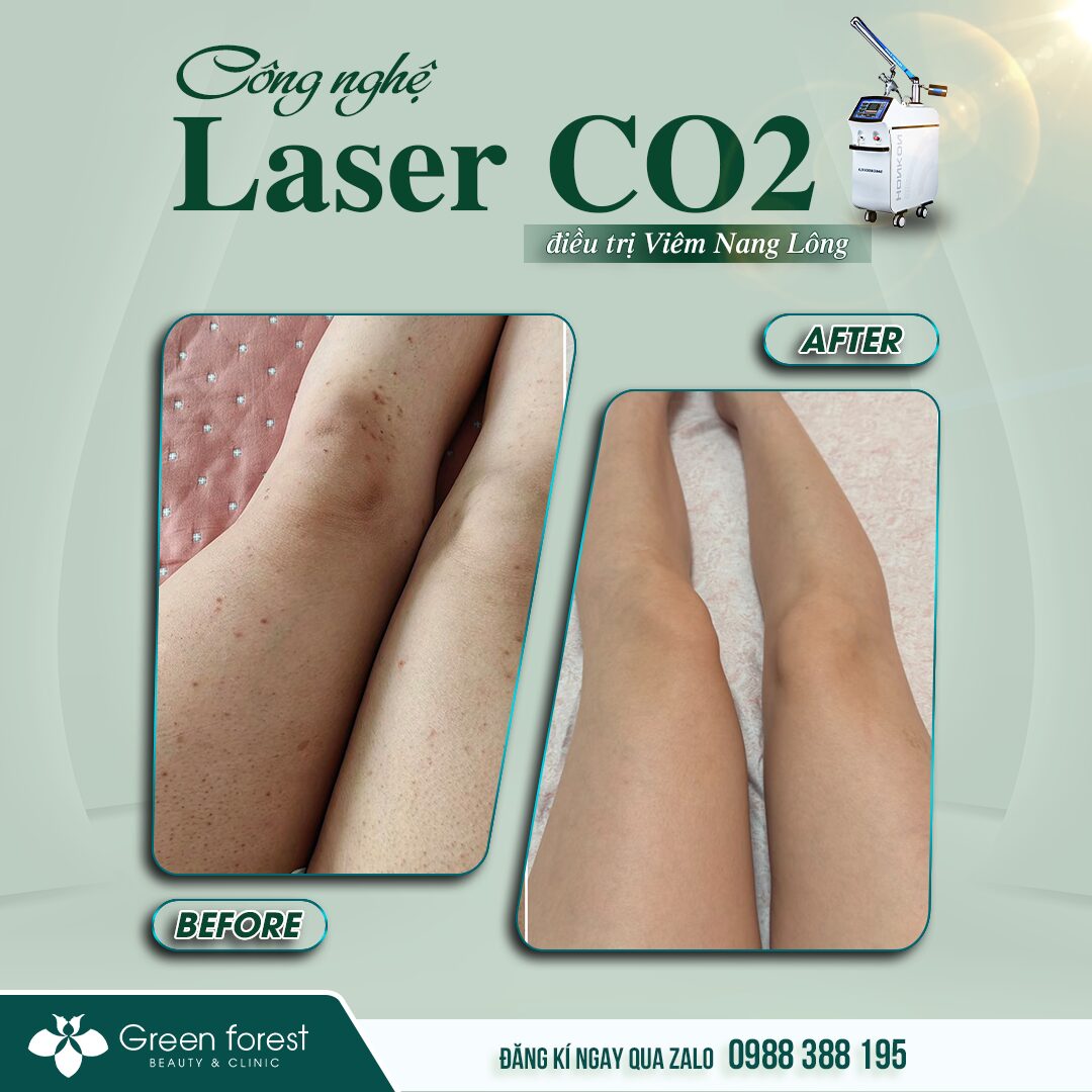 Kết quả điều trị viêm nang lông ở chân