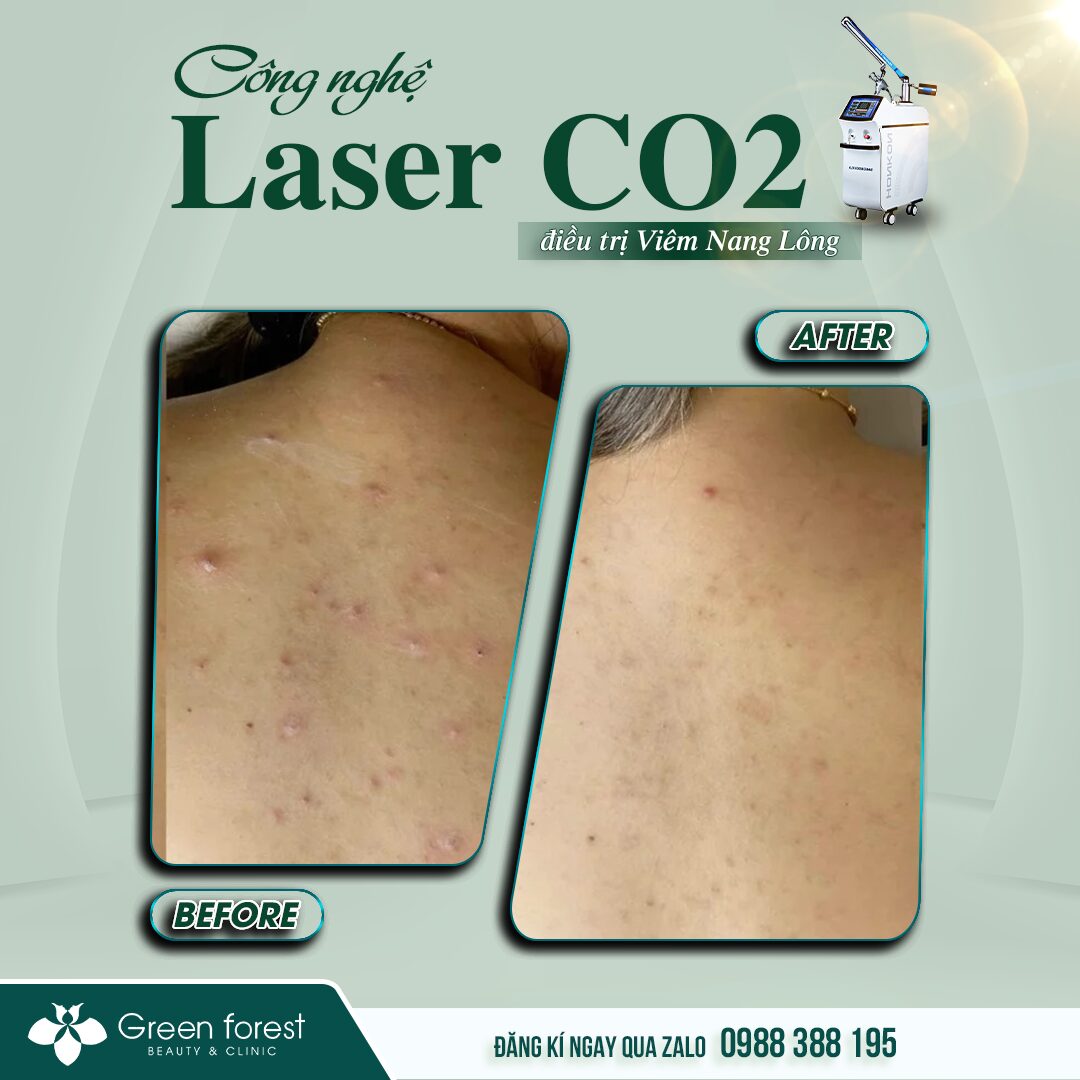 Điều trị viêm nang lông nách dứt điểm